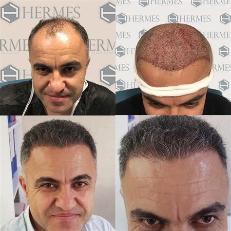 hermes hair transplant clinic|Hermes hair transplant reviews.